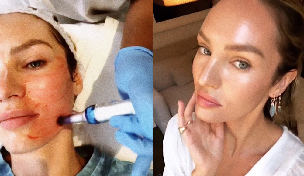 Candice Swanepoel PRP Facial Before and After | Sea Beauty North Beach